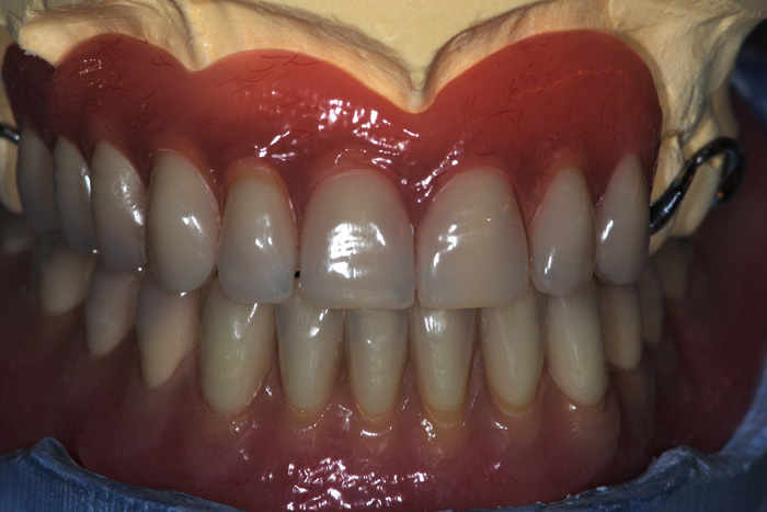 R&eacute;alisation de tous types de proth&egrave;se sur implants